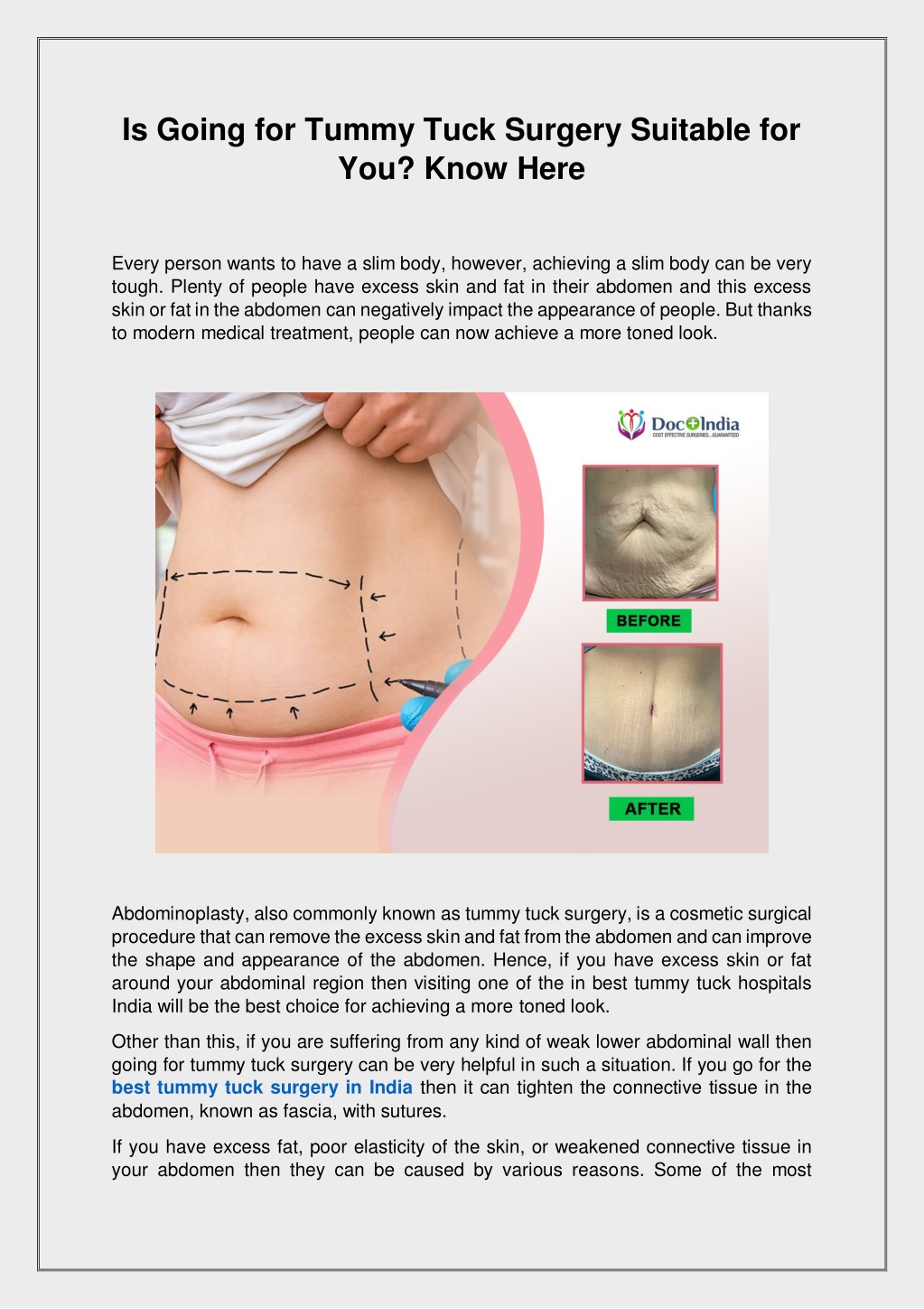 Ppt Is Going For Tummy Tuck Surgery Suitable For You Powerpoint Presentation Id12149559