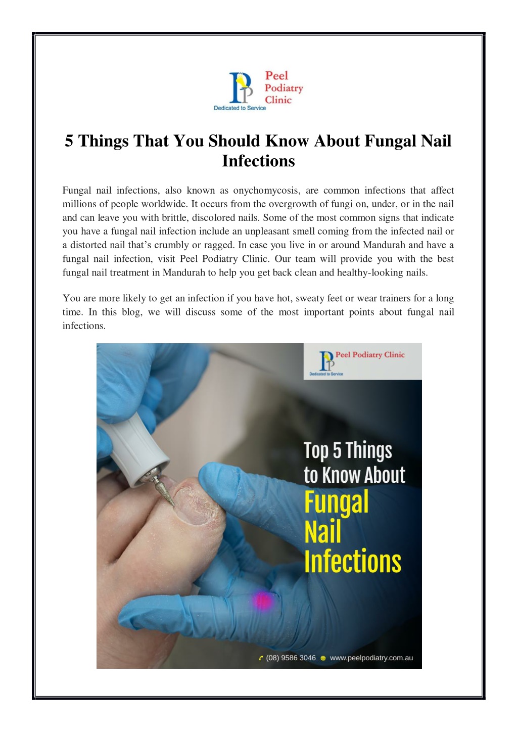 5 things that you should know about fungal nail l