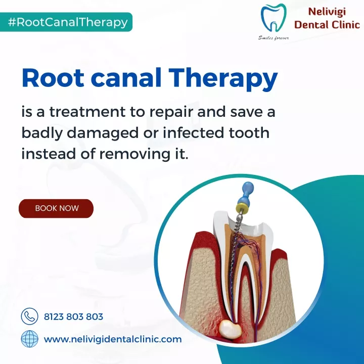 PPT - Get treated an infected tooth with Root canal treatment ...