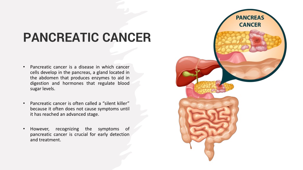 Ppt Pancreatic Cancer Symptoms Cause And Treatments Options Powerpoint Presentation Id