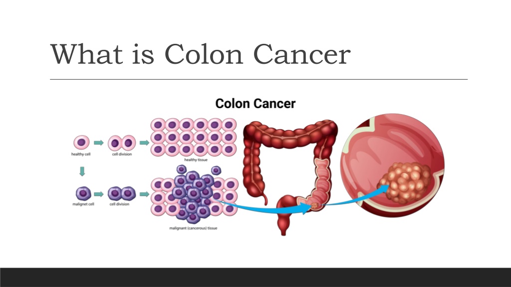 PPT - Colon Cancer in Young Adults: What You Need to Know PowerPoint ...