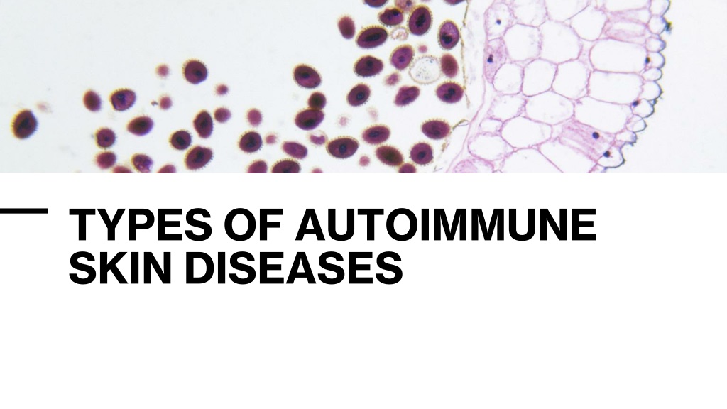 Ppt Types Of Autoimmune Skin Diseases Powerpoint Presentation Free Download Id12262118