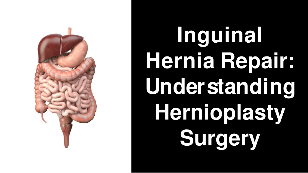 Ppt Inguinal Hernia Hernioplasty Surgery Powerpoint Presentation