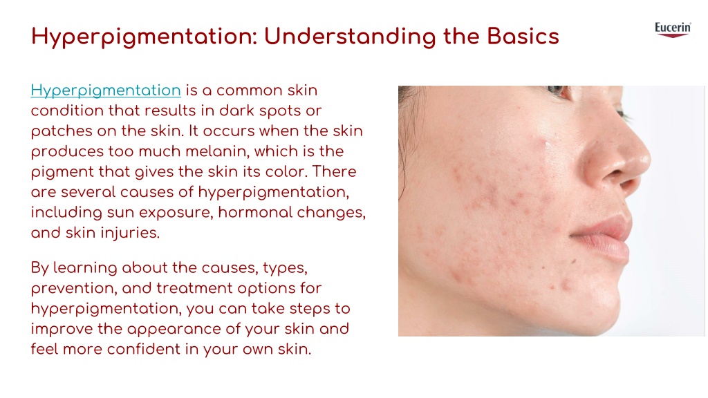 PPT - Hyperpigmentation_ Causes, Types, And Treatment PowerPoint ...