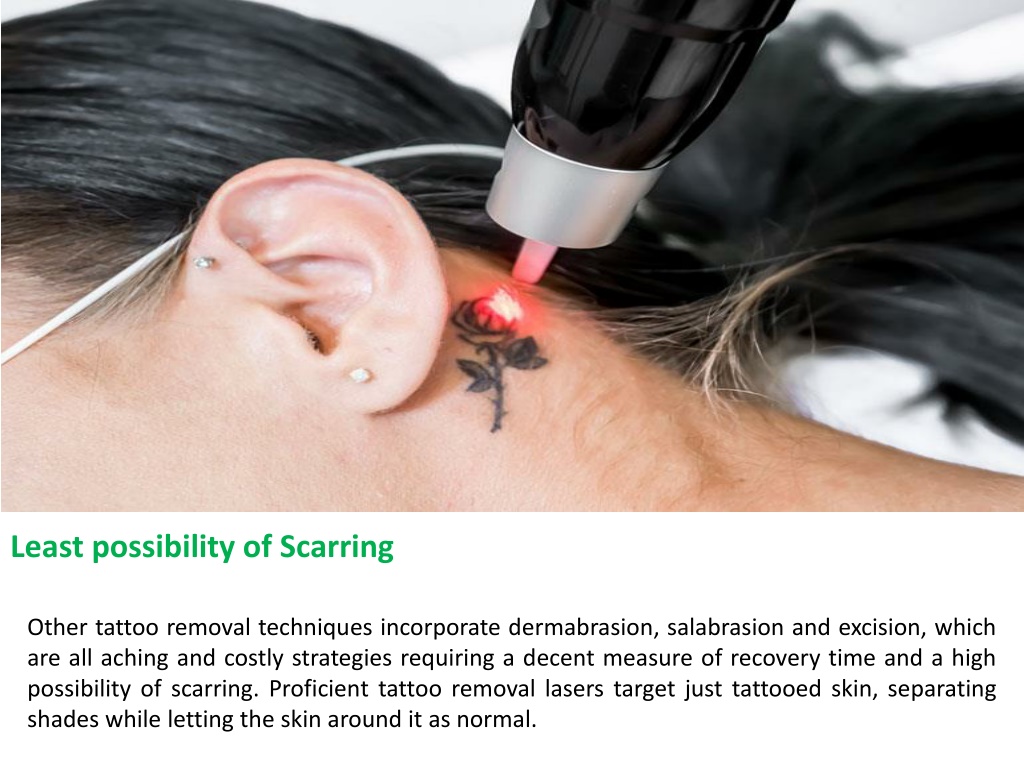 Tattoo Removal Methods | Removery