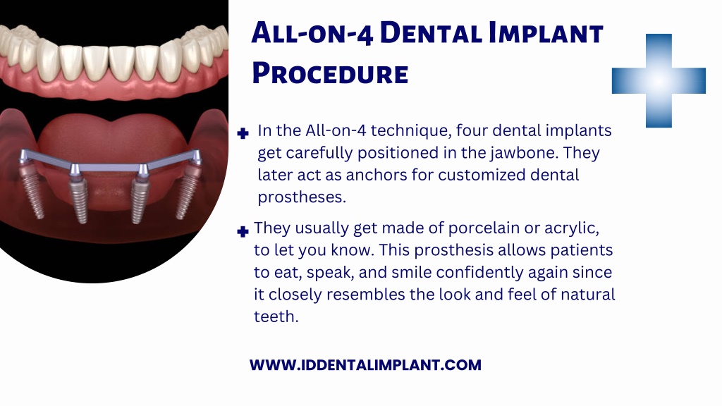 Ppt All On Four Dental Implants Los Angeles Id Dental And Implant Center Powerpoint