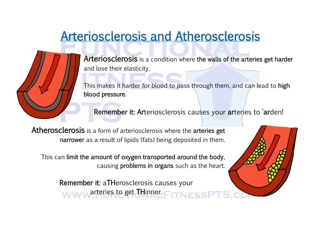 PPT - Arteriosclerosis and Atherosclerosis PowerPoint Presentation ...