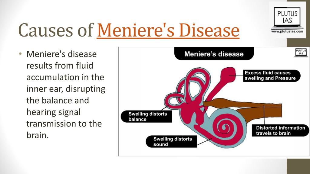 Ppt Menieres Disease Powerpoint Presentation Free Download Id12589155 4639