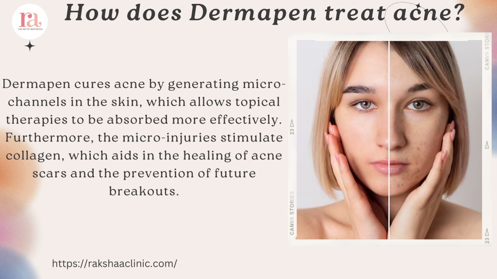 PPT - What exactly is a Dermapen and how does it work? PowerPoint ...