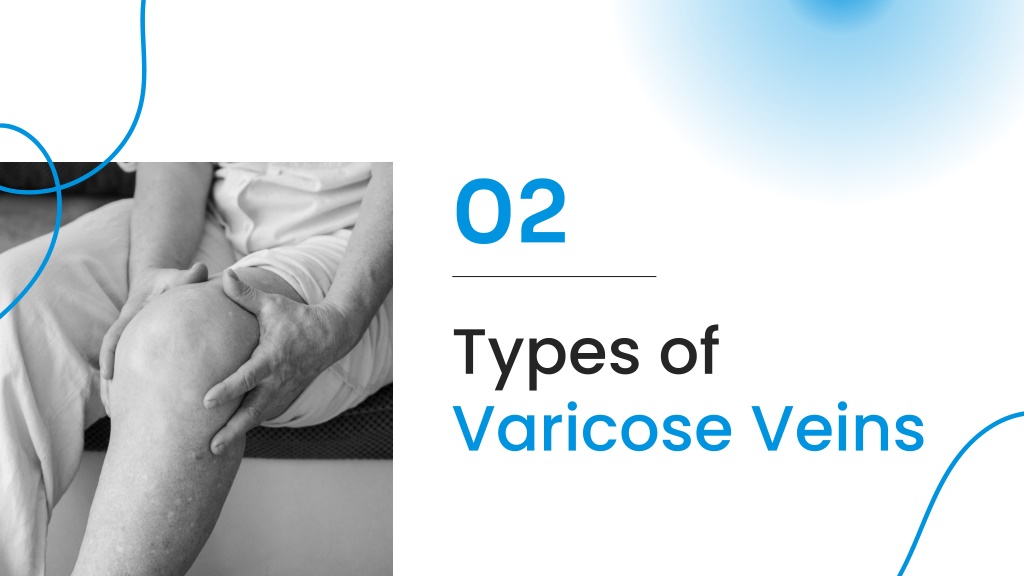 PPT - Varicose Veins Types & Symptoms PowerPoint Presentation, Free ...