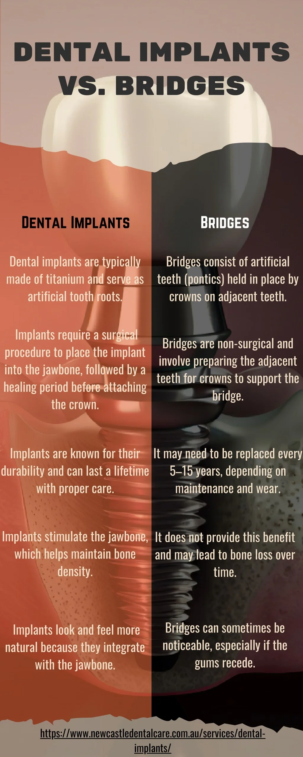 PPT - Dental Implants vs. Bridges PowerPoint Presentation, free ...