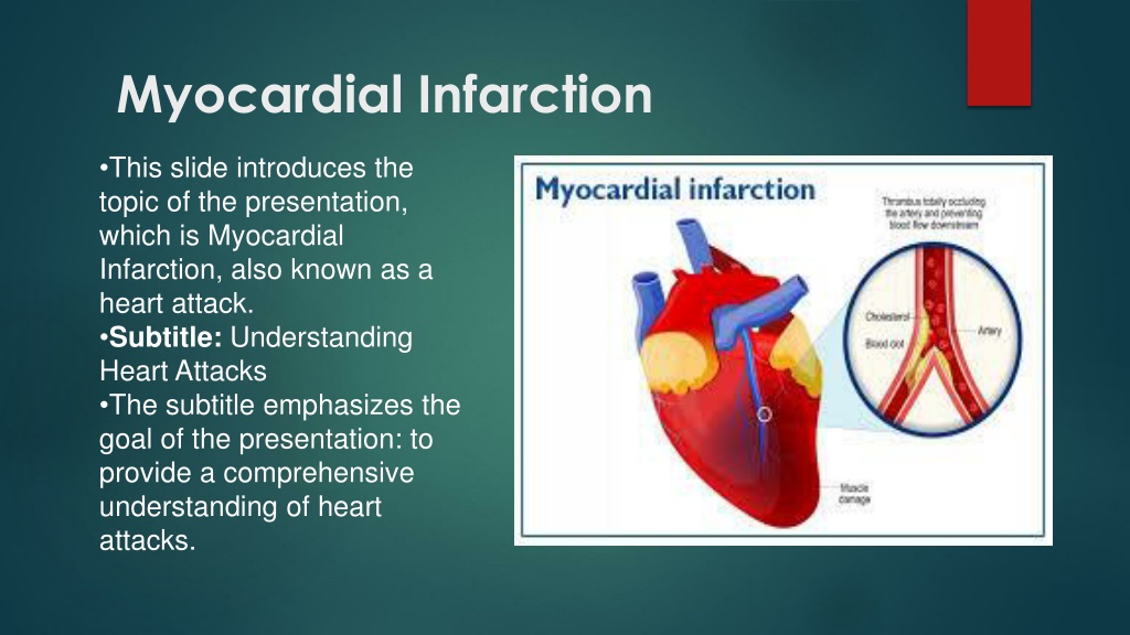 PPT - Understanding Myocardial Infarction: Pathophysiology, Diagnosis ...