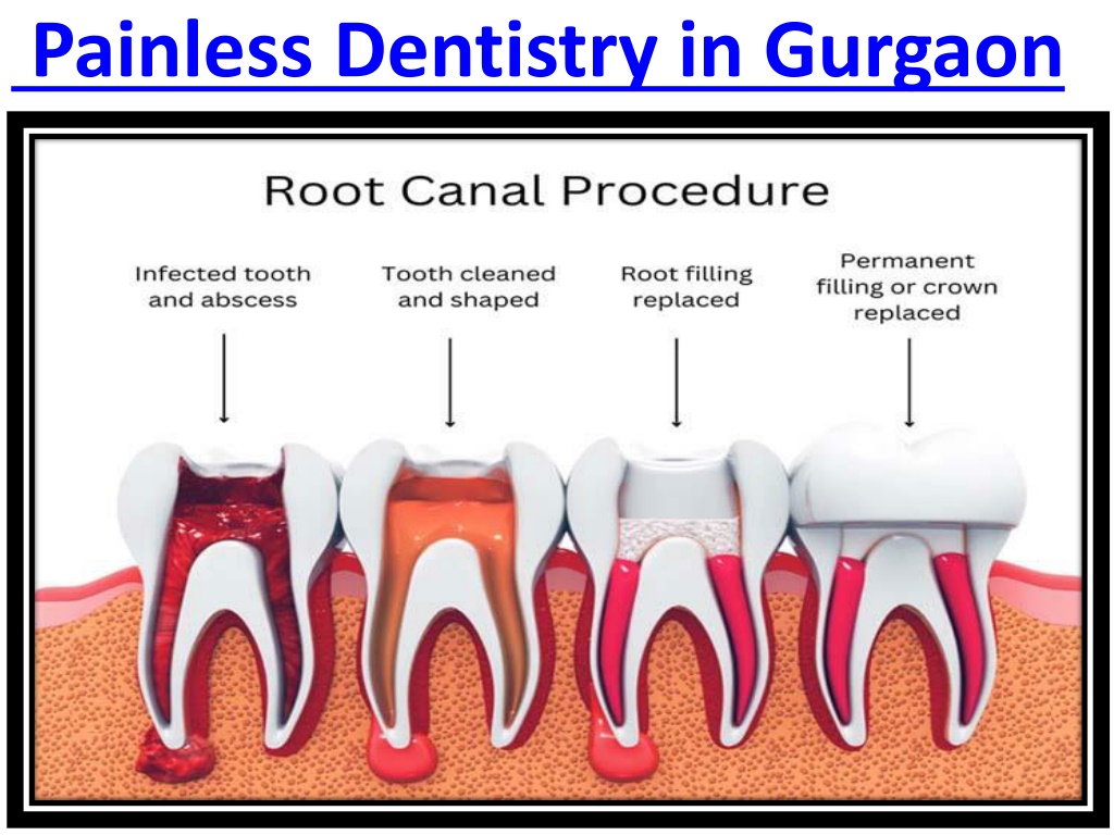 PPT - Painless Root Canal Treatment Dentistry in Gurgaon PowerPoint ...