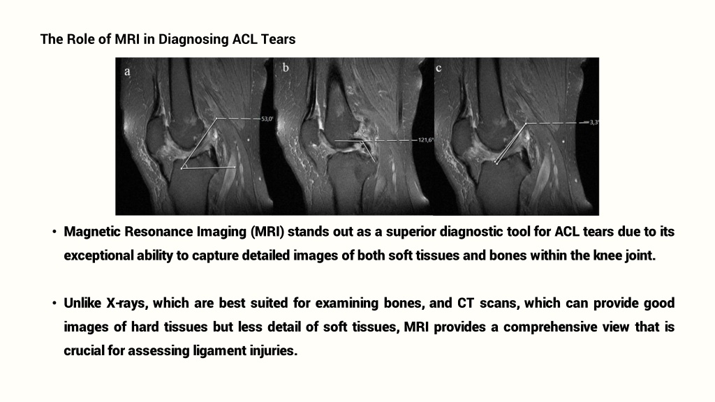 PPT - Pristyn Care - MRI in Diagnosing ACL Tears Image Techniques and ...