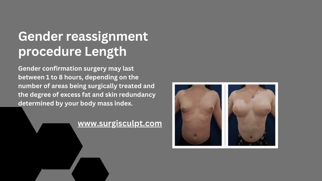 Ppt Gender Reassignment Services Are Provided By Surgisculpt Powerpoint Presentation Id 13356134