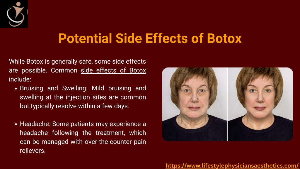 PPT Botox Injections Treatment, Recovery & Side Effects Lifestyle's